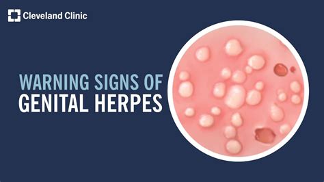 Genital Herpes on Shaft: Symptoms, Diagnosis,。